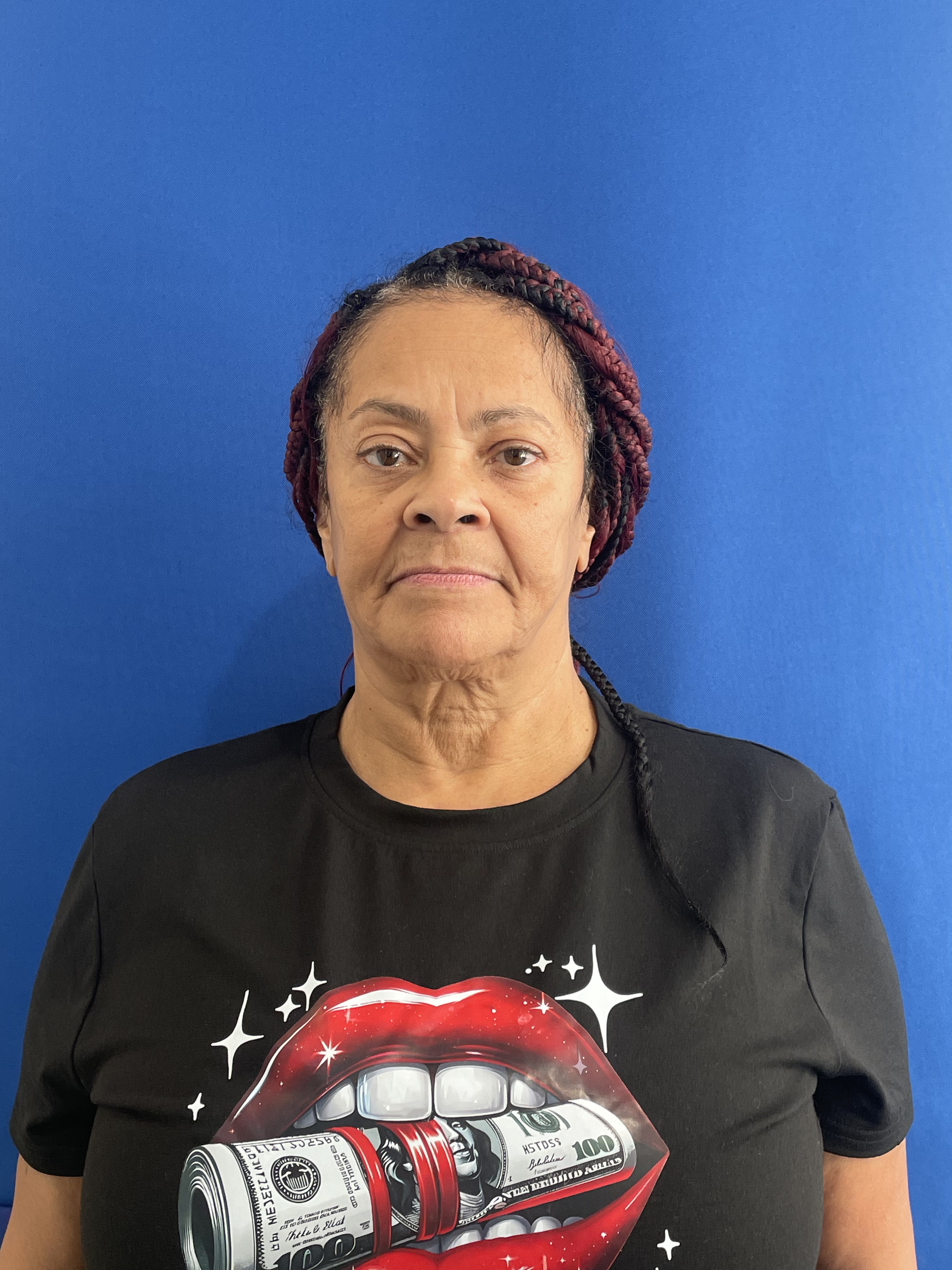 Before — Complete arch rehabilitation — natural-looking results