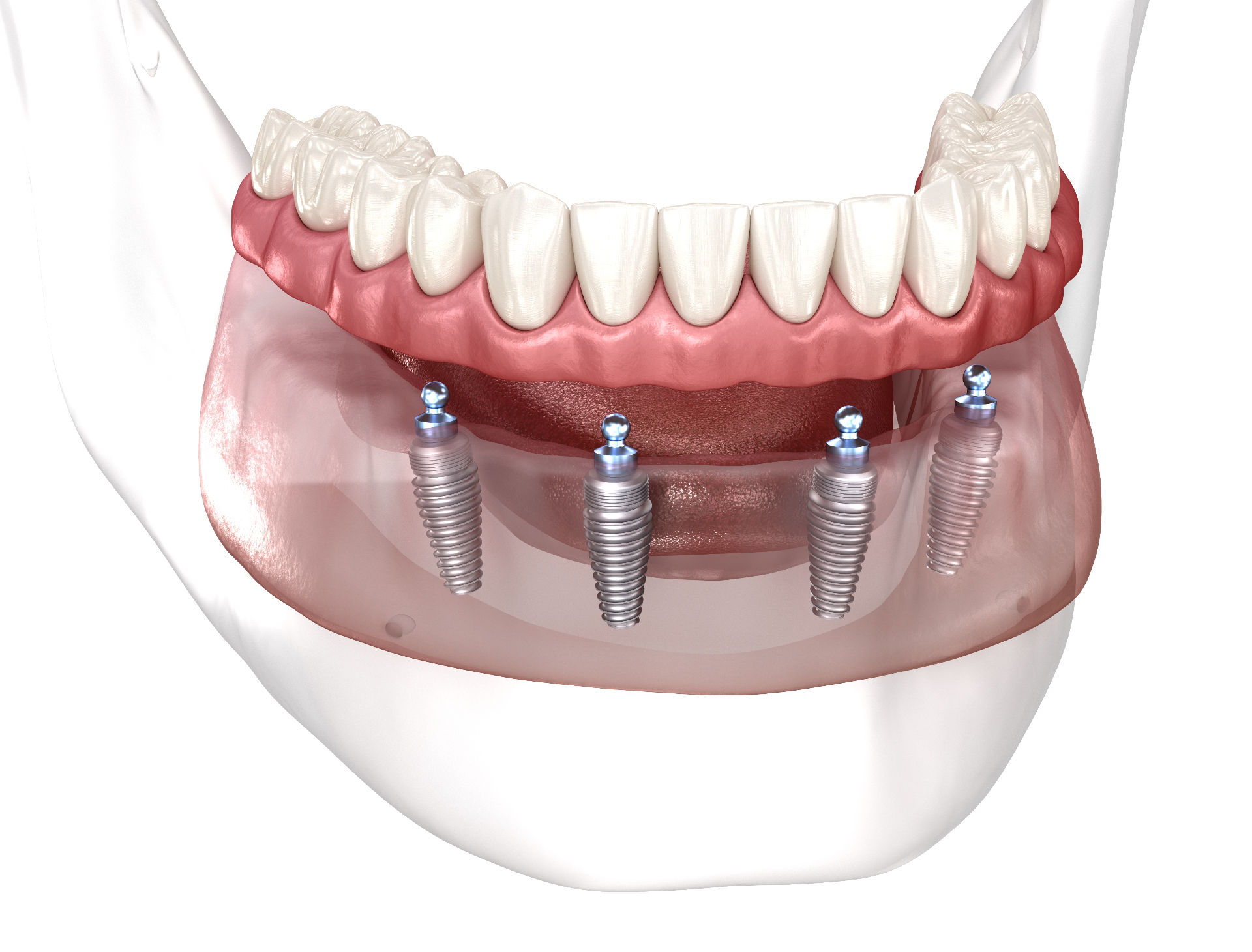 All-on-4 / Full-Arch Restoration