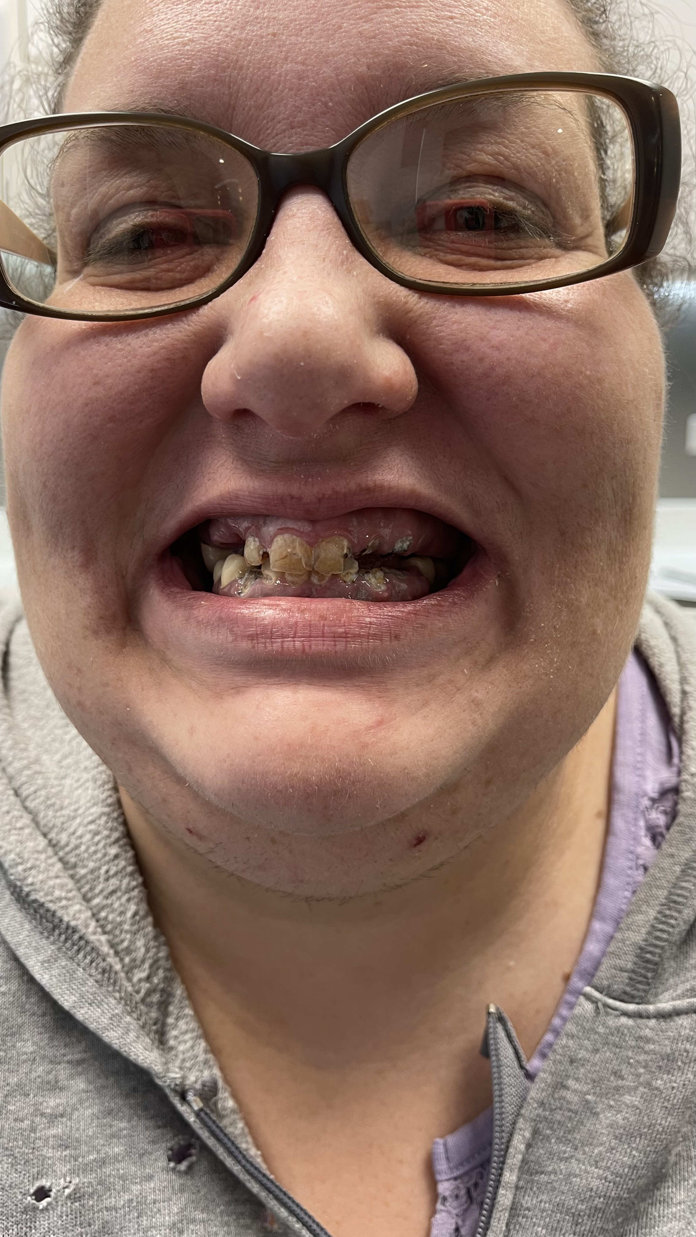 After — Renewed smile — beautifully natural results