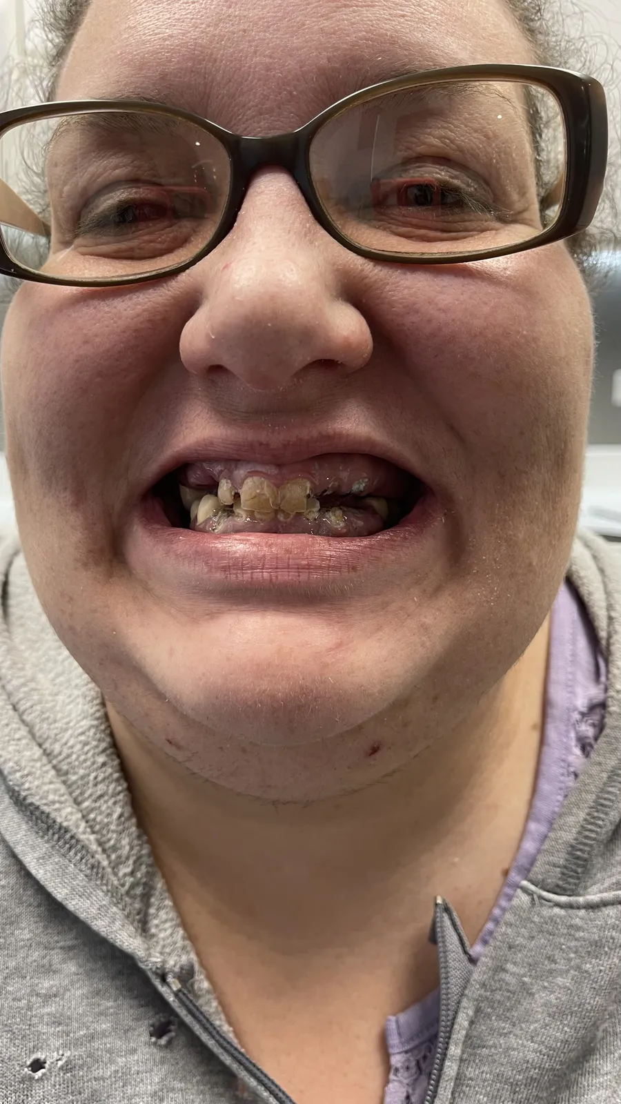 Before — Renewed smile — beautifully natural results