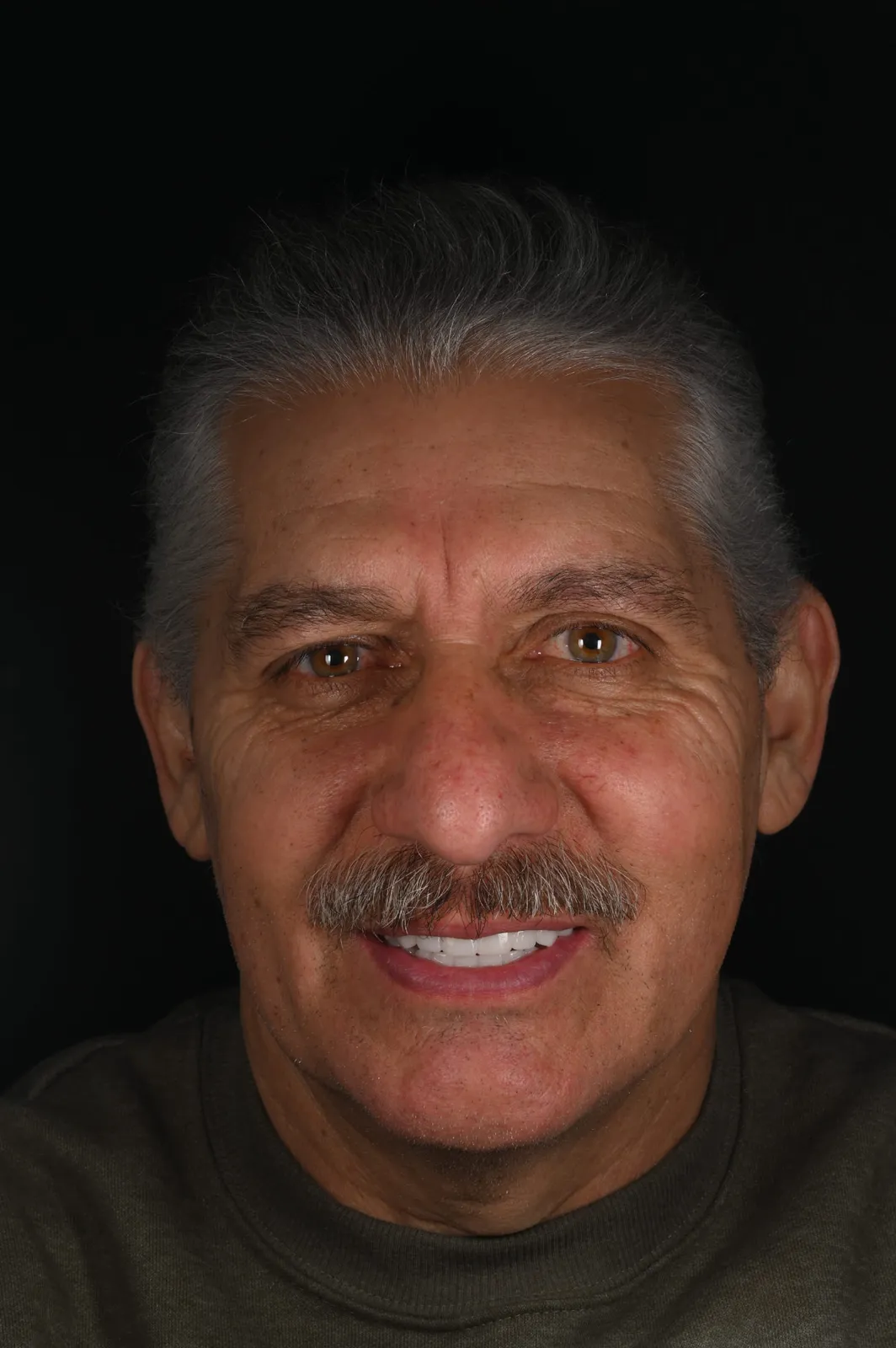After — Failing teeth to a brand-new smile