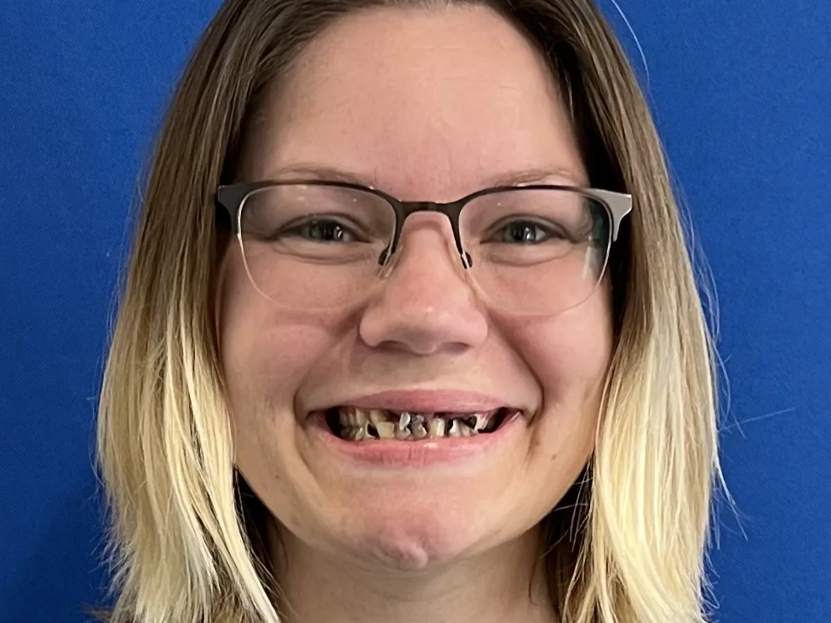 Before — Missing teeth replaced — a strong, confident smile