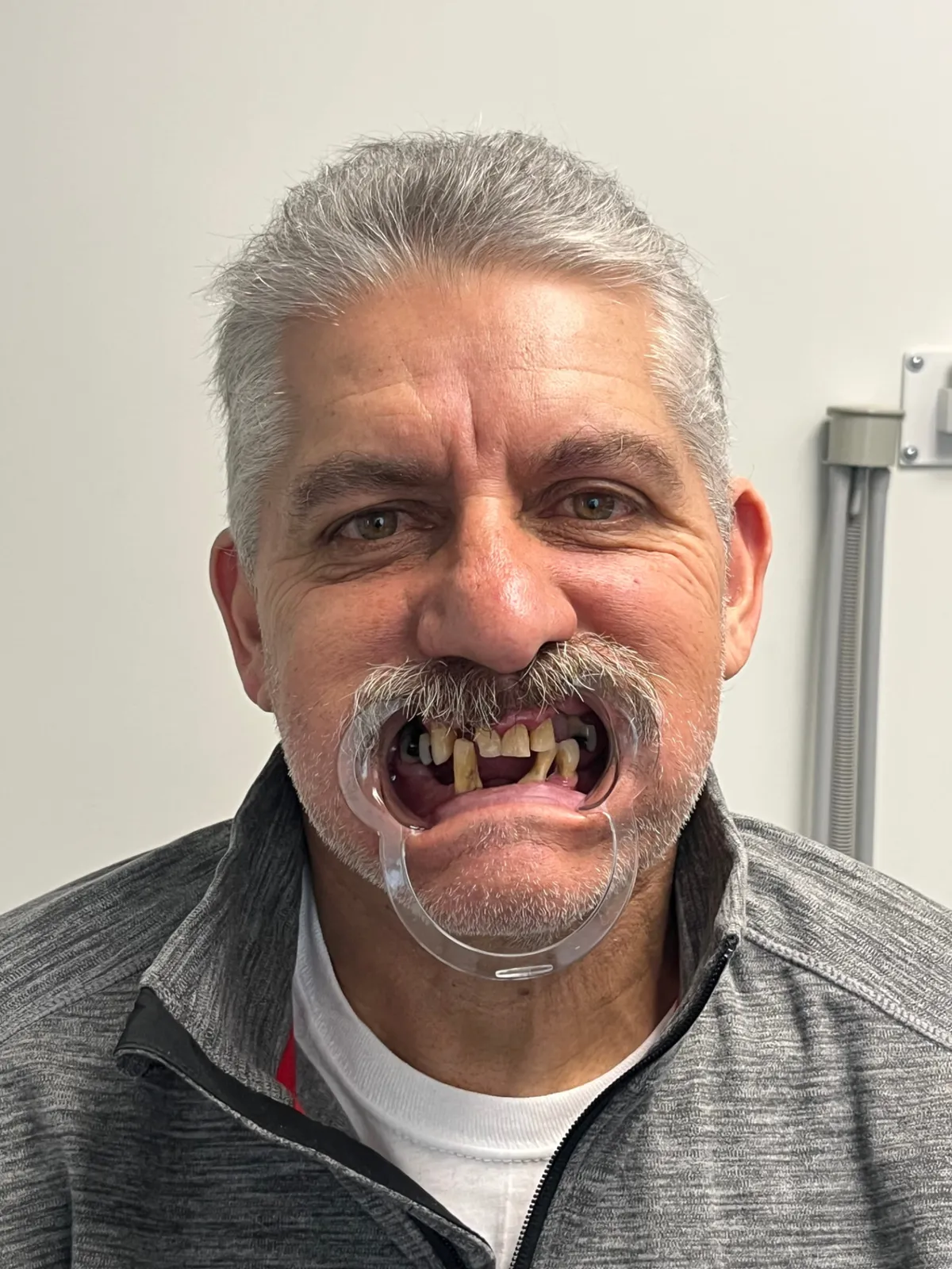 Before — Failing teeth to a brand-new smile