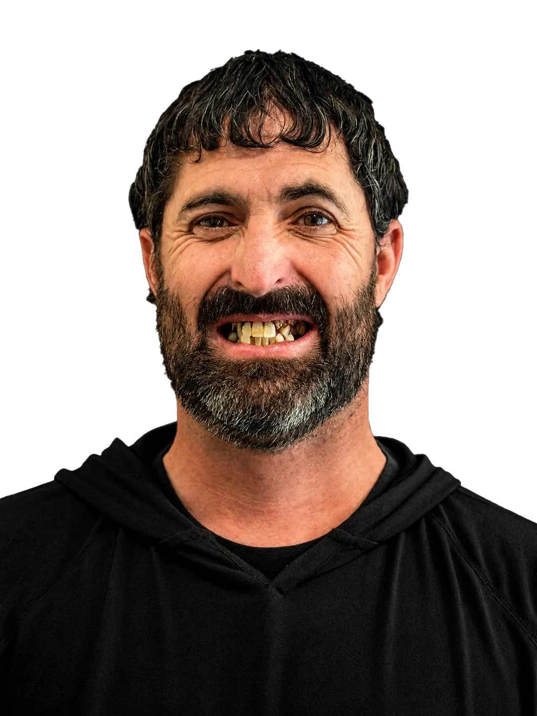Before — Full smile restoration — confidence restored